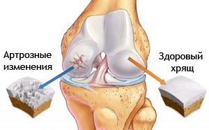 Новое в лечении суставов