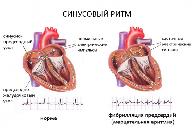 Мерцательная аритмия