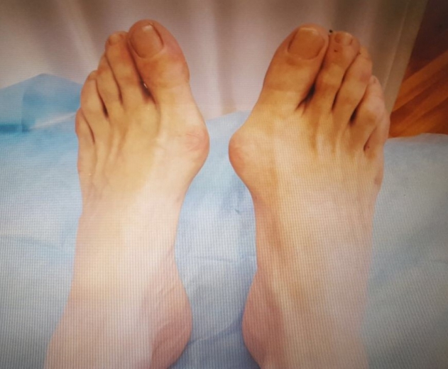 Косточки на пальцах ног