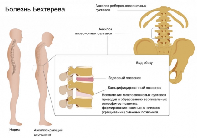 Болезнь Бехтерева причины симптомы диагностика и лечение