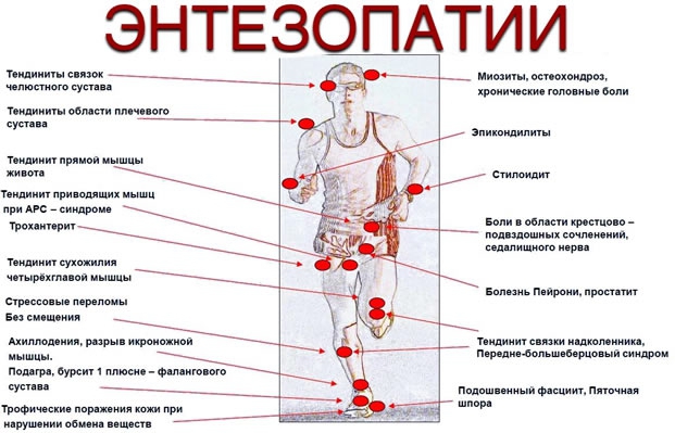 Энтезопатия коленного сустава причины и методы лечения | Научно-медицинский портал