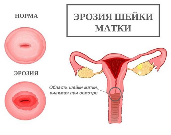 Реферат: Эрозии шейки матки