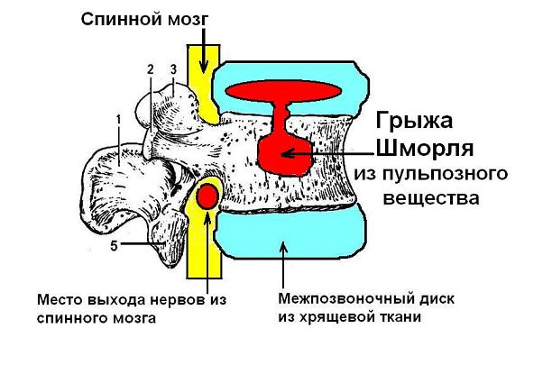 Лечение грыжи Шморля