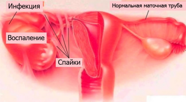 Реферат: Обострение хронического сальпингоофорита