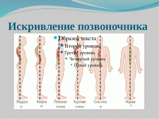 Лордоз - Центр доктора Бубновского