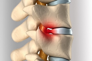 Грыжа межпозвонкового диска