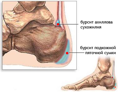 бурсит лечение