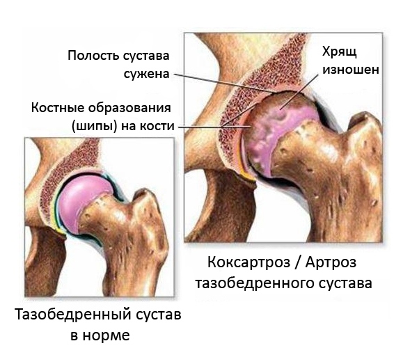 Симптомы синовита тазобедренного сустава