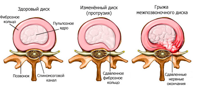 Как вылечить грыжу позвоночника? | Med &amp; Care