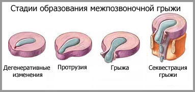 стадии образования межпозвонковой грыжи