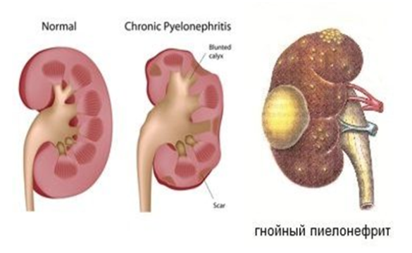 Виды пиелонефрита